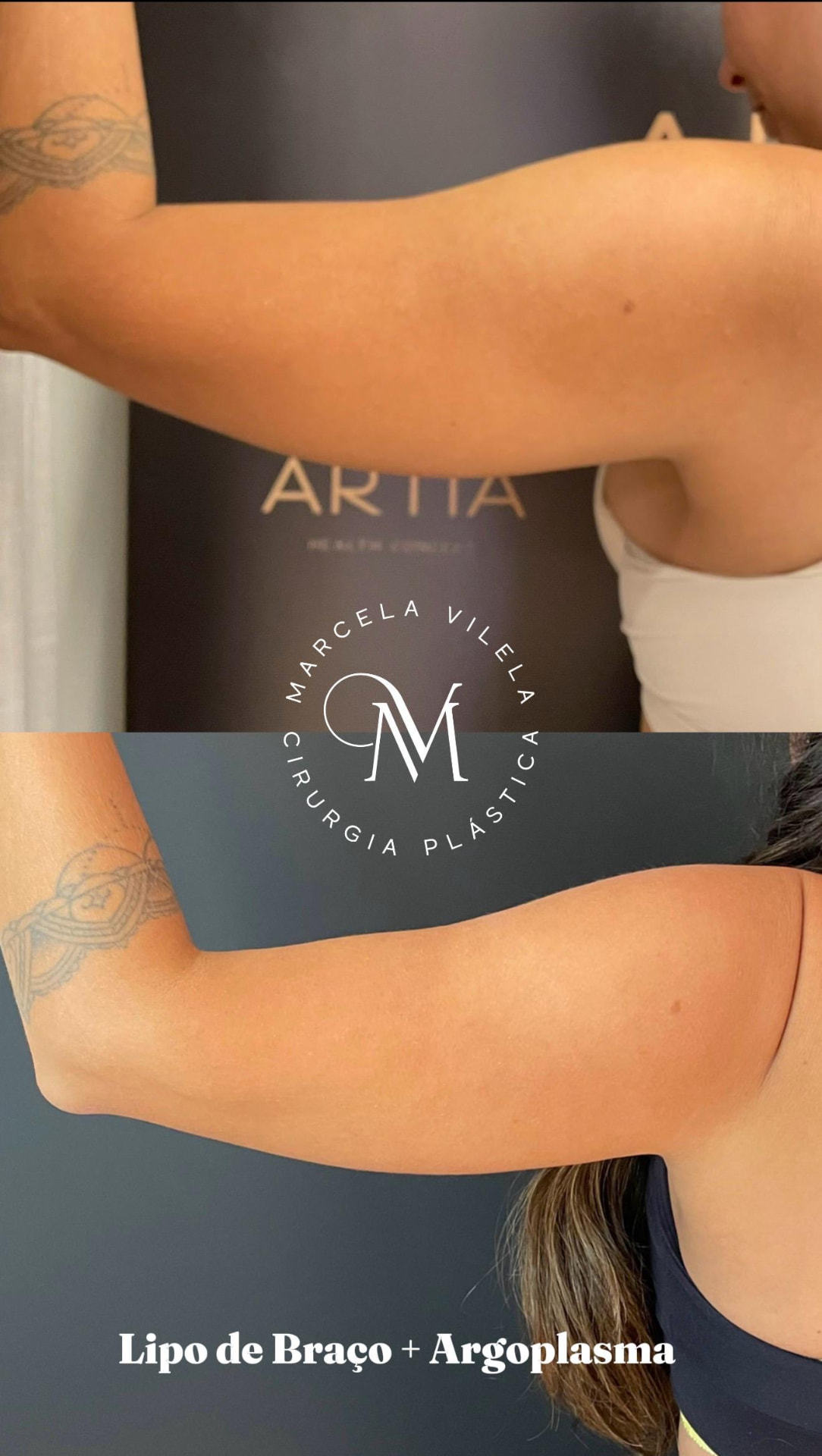 Antes e depois — Lipo de braço + Argoplasma: Resultado de contorno do braço