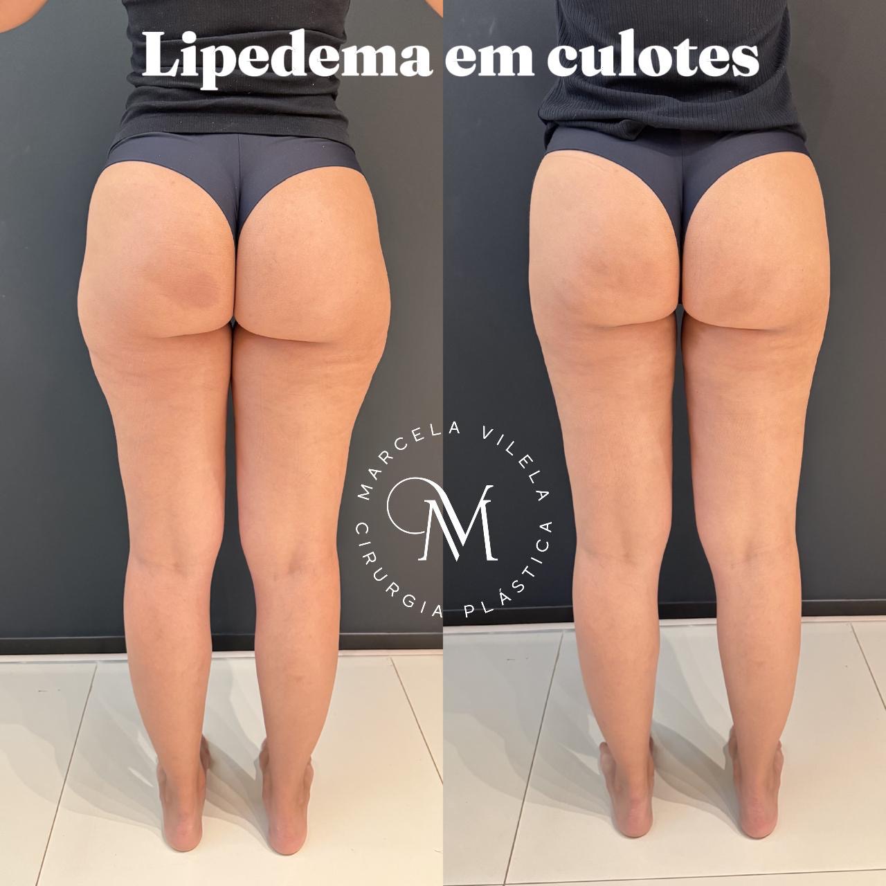 Antes e depois — Lipedema em culotes: Harmonia de culotes e glúteos — vista posterior