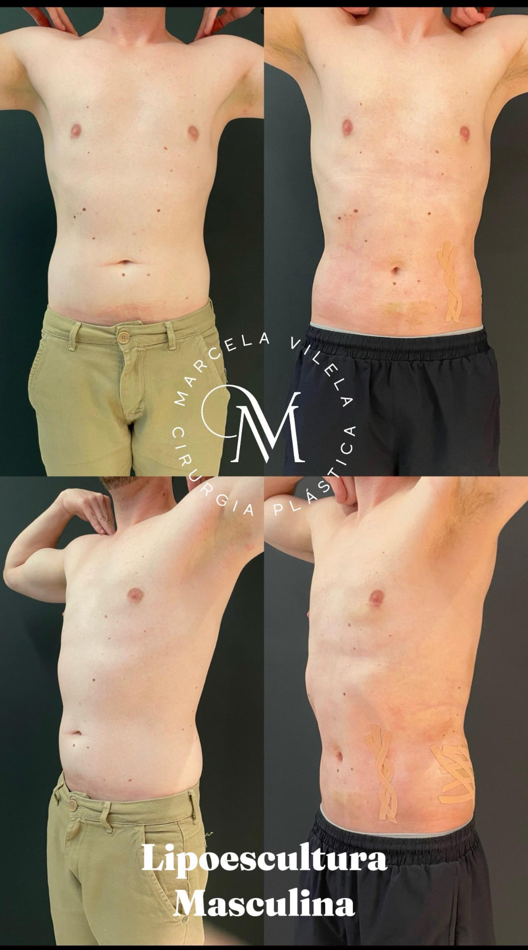 Antes e depois — Lipoescultura masculina: Definição de tronco
