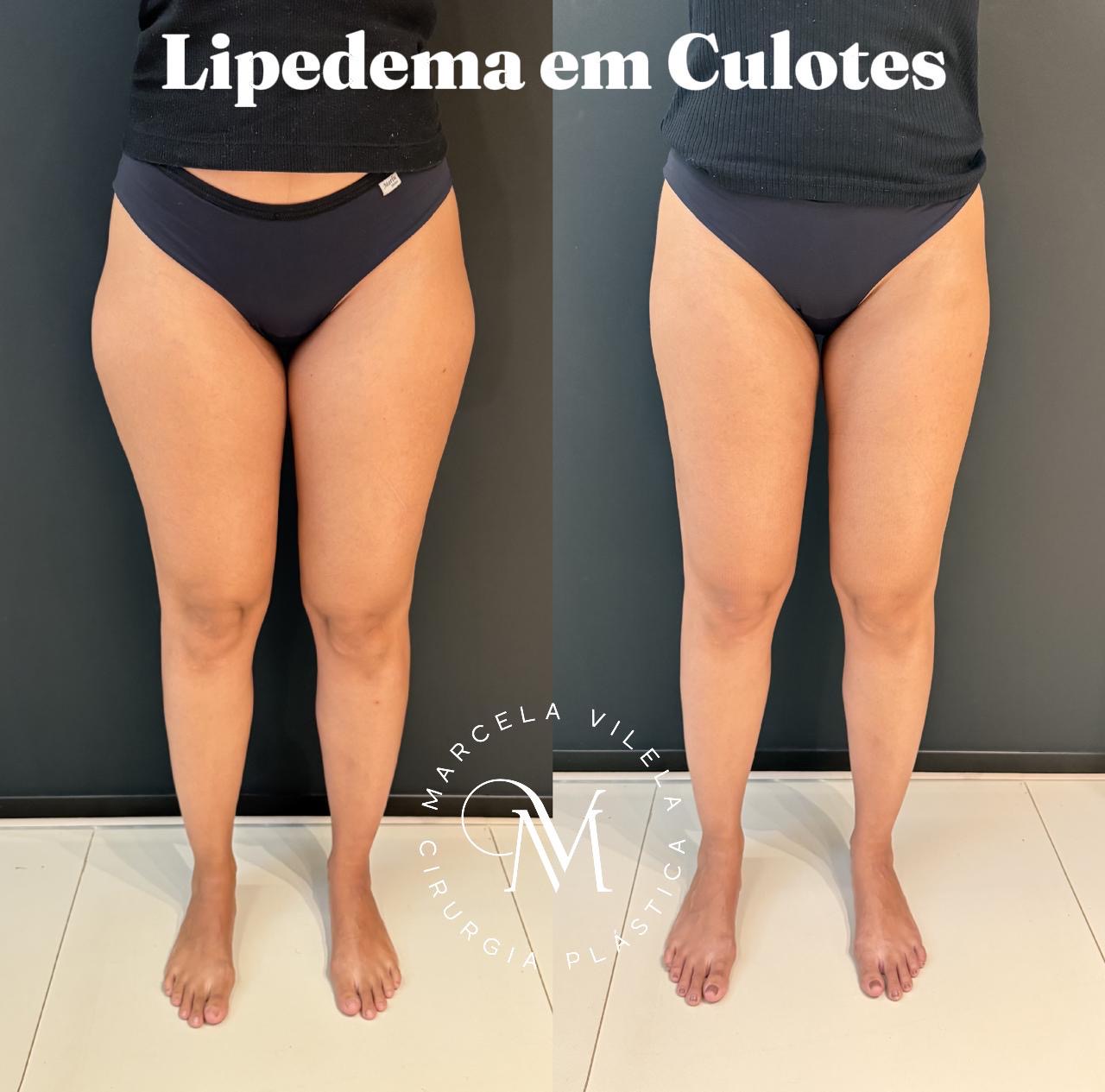 Antes e depois — Lipedema em culotes: Contorno de coxas e quadril — vista frontal