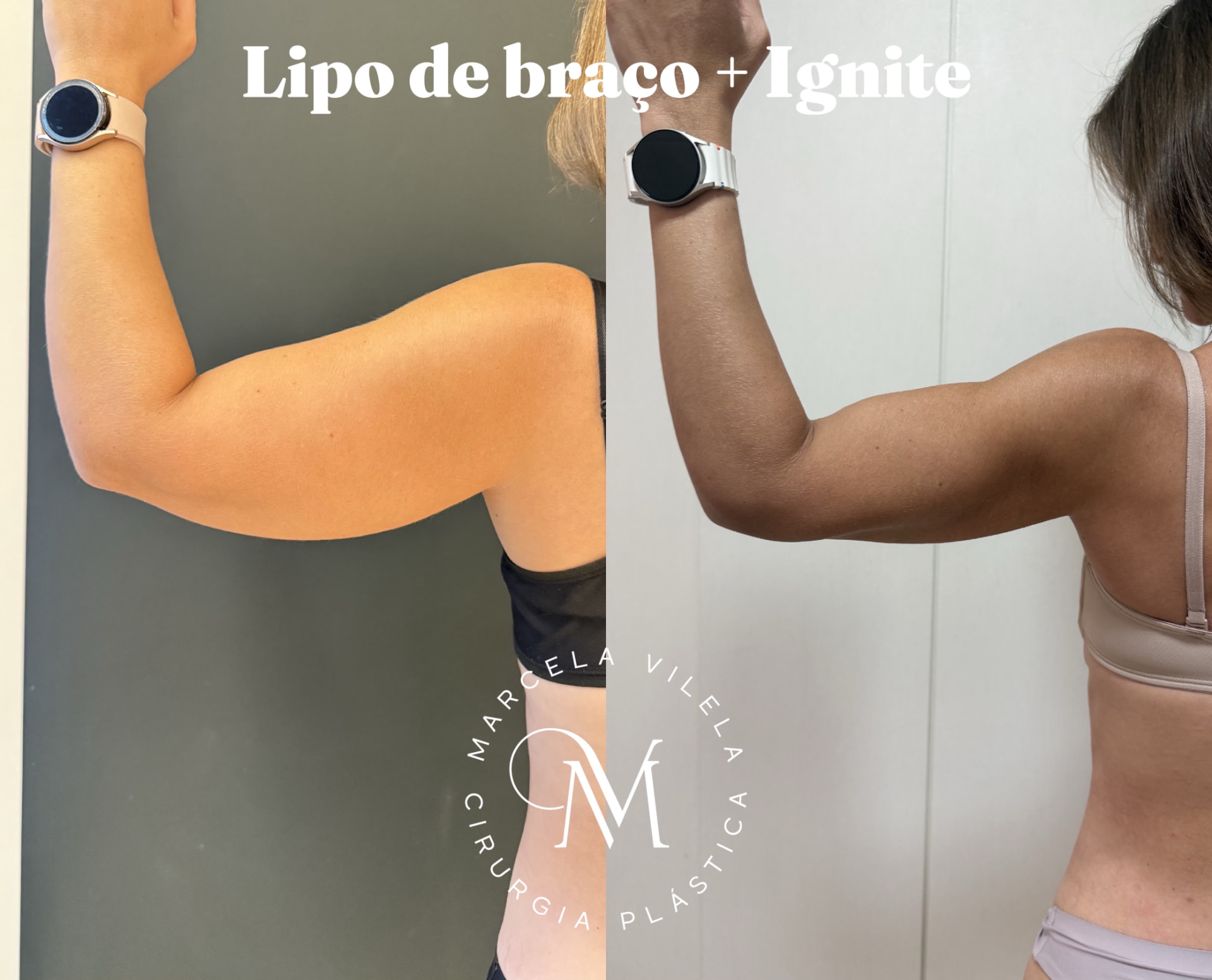Antes e depois — Lipo de braço + Ignite: Contorno de braço em outro ângulo