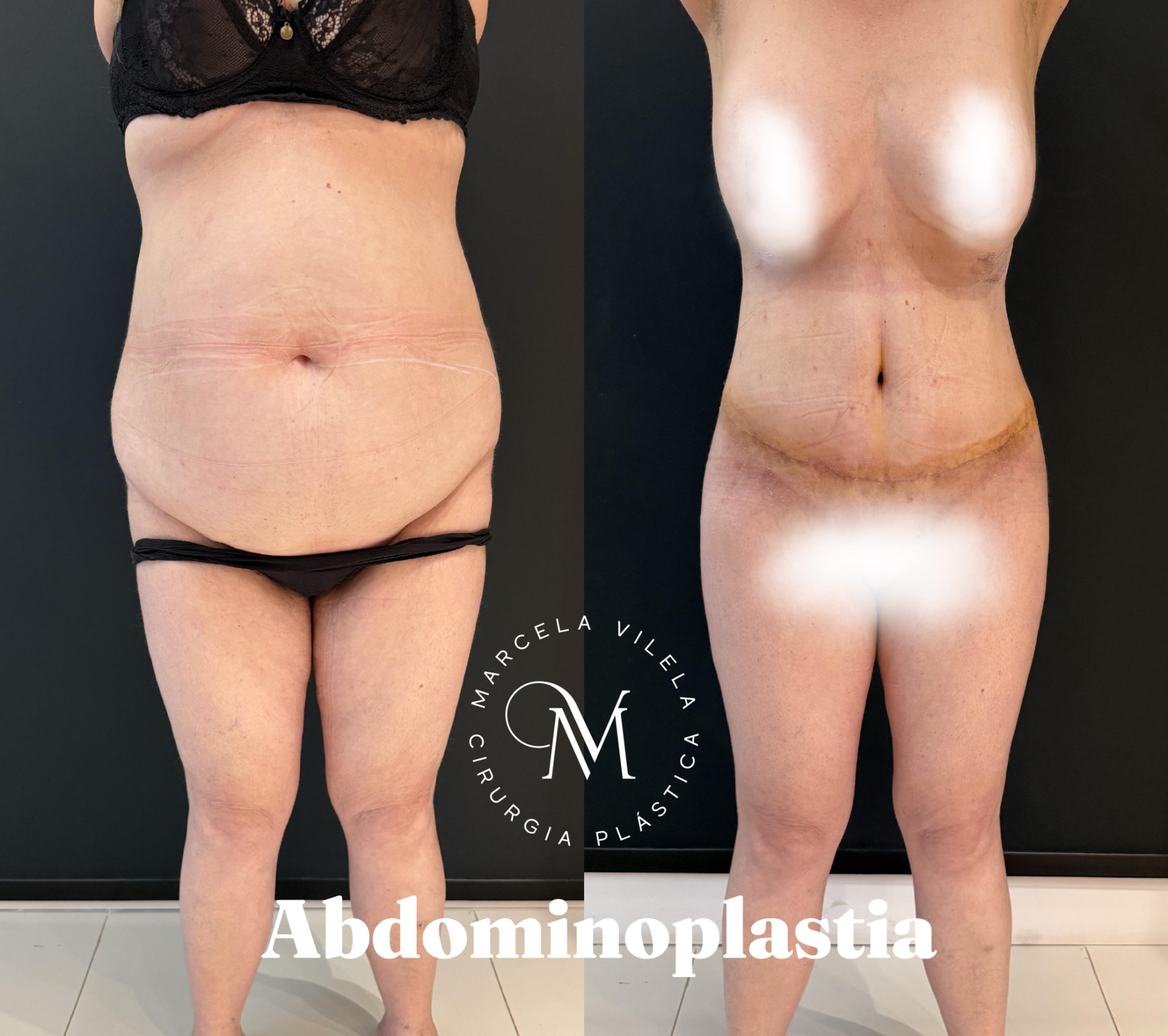 Antes e depois — Abdominoplastia: Reconstrução da parede abdominal