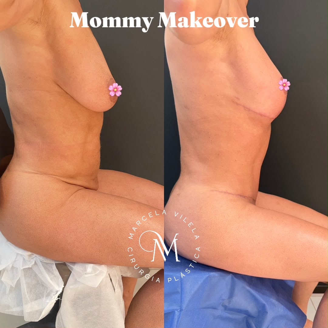 Antes e depois — Mommy Makeover: Mama e abdome no mesmo tempo cirúrgico