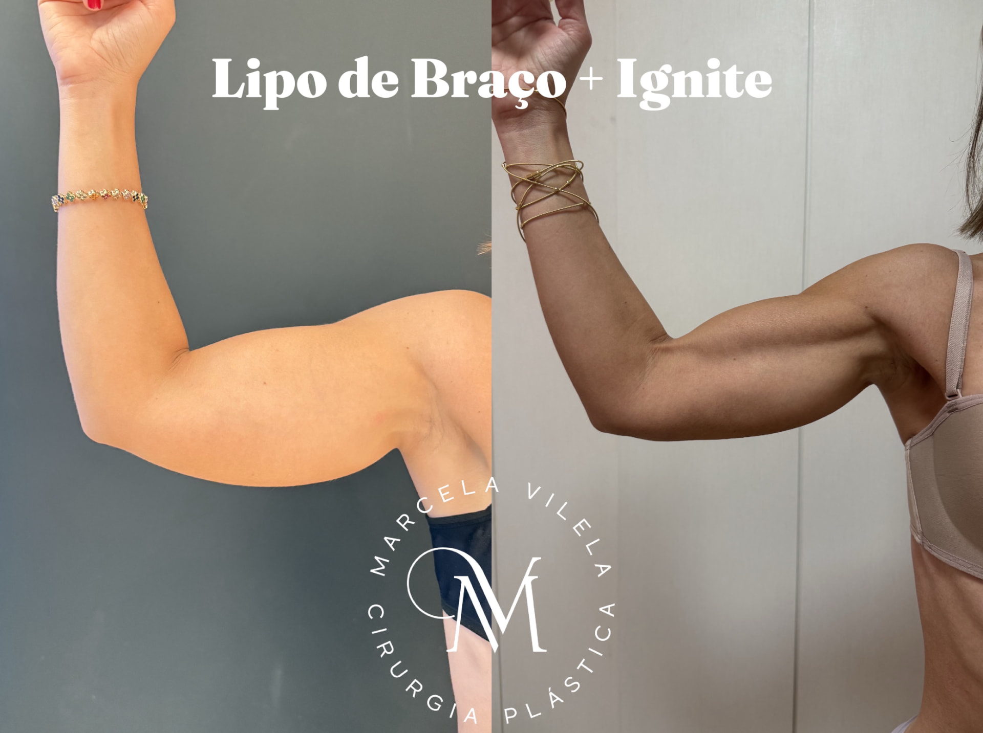 Antes e depois — Lipo de braço + Ignite: Definição de braço com retração de pele