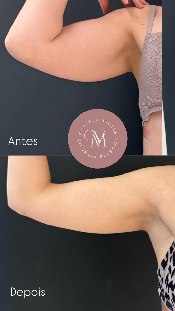Antes e depois — Lipo de braço: Antes e depois do contorno do braço